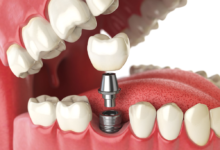 Removal of Dental Implants – Is it Possible?
